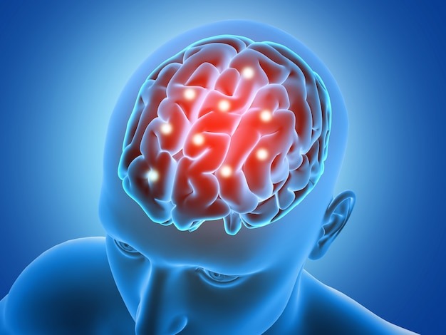 Brain Stroke
