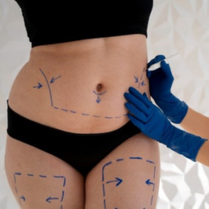 Benefits of Liposuction Surgery