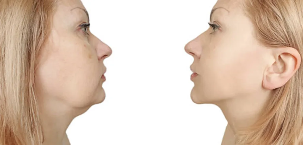 Success-Rates-Of-Liposuction-In-Navi-Mumbai