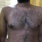 Success Rates Of Our Gynecomastia Surgery In Navi-Mumbai