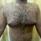 Success Rates Of Our Gynecomastia Surgery In Navi-Mumbai
