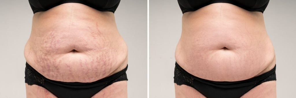 before and after liposuction surgery result